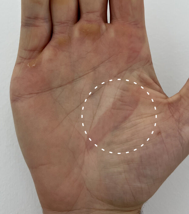 Image of hand with a burn on the palm